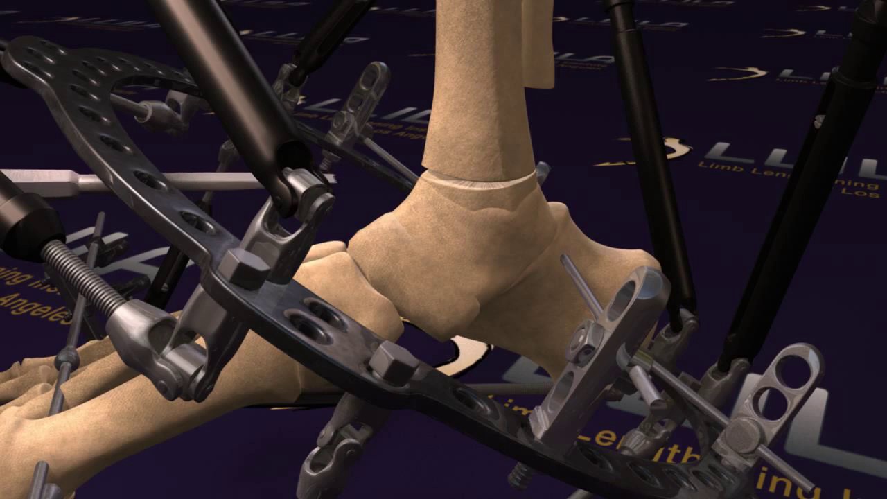 External fixation taylor spatial frame for correction of ankle deformity