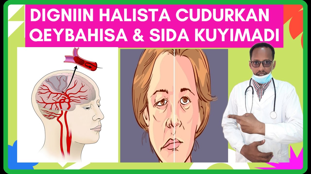 CUDURKA DILAGA FAALUG ( STROKE ) QEYBAHA KALA BAXO WAX KENA &  SAMEYNTISA DR. MAHAMED LIBAN MAHAMED