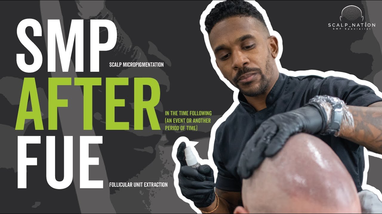 Scalp Micropigmentation (SMP) AFTER FUE HAIR TRANSPLANT - Donor Area Scar Cover Up