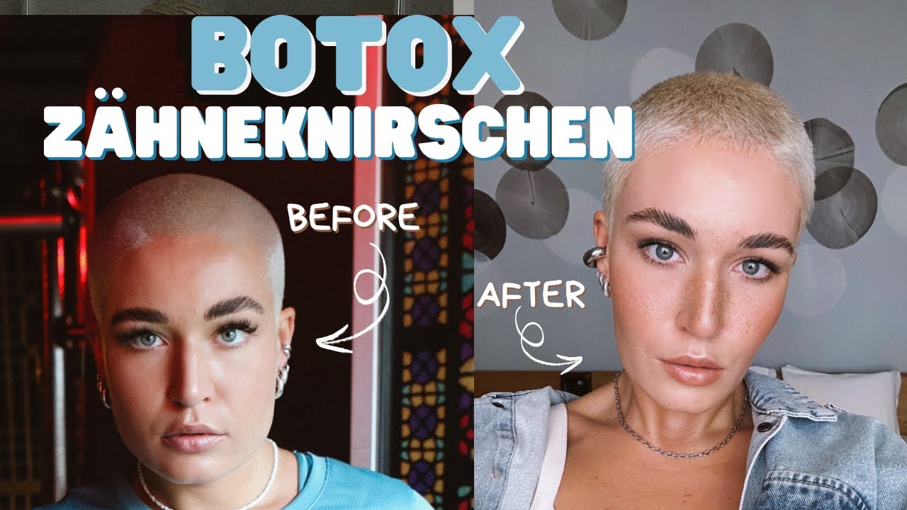 Botox gegen Zähneknirschen - Behandlung & Erfahrung! Masseter-Botox für ein schmäleres Gesicht?