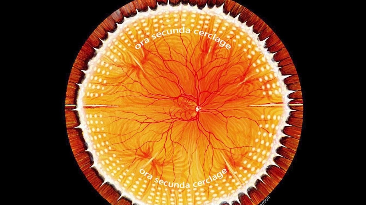 Retinal detachment: Encircling laser retinopexy technique - Video abstract [ID 406337]