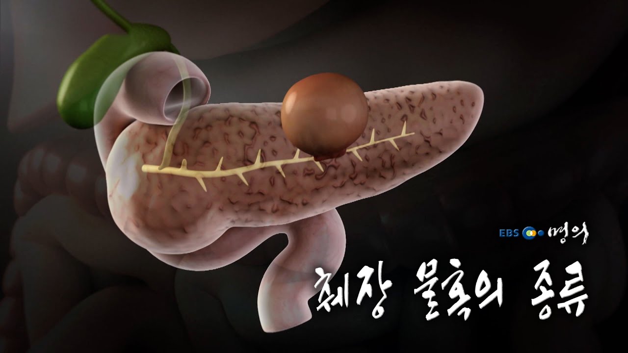 [명의 의학백과📖] 췌장 물혹의 종류