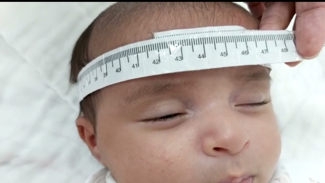 Case 627 How to approach for large head ? macrocephaly, familial, hydrocephalus,MPS,hypothyroidism