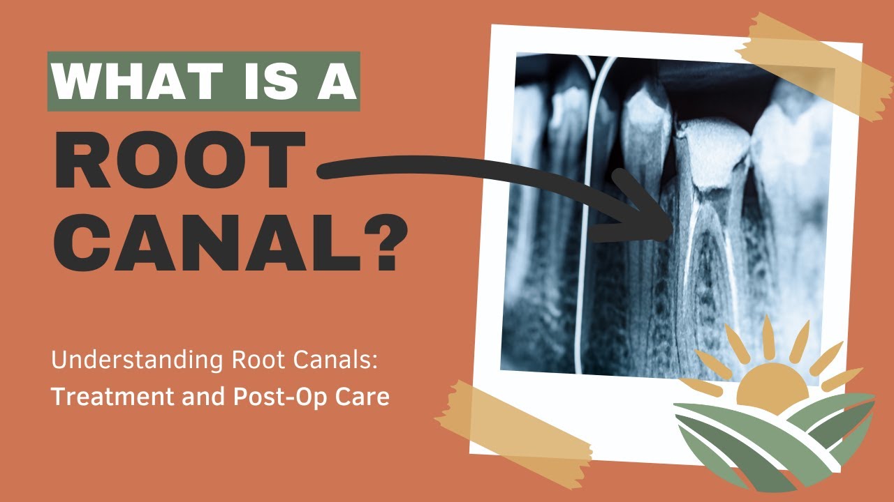 What is a Root Canal? Understanding Dental Root Canals: Treatment and Post-Op Care