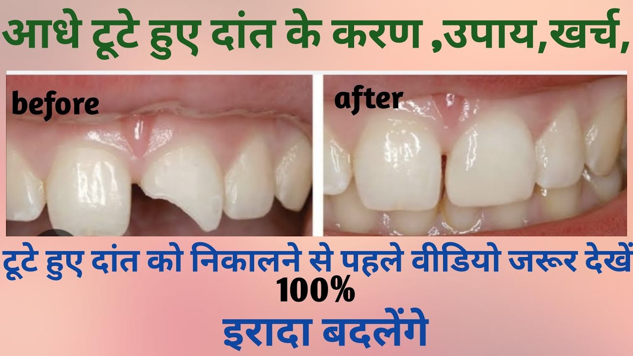 fractured tooth treatment/aadhe tute hue danto ka ilaaj