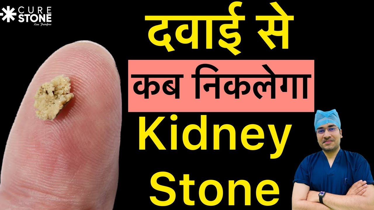 दवाई से कब निकलेगा Kidney Stone | Can Allopathy medicines treat your kidney stones? RIRS (laser)