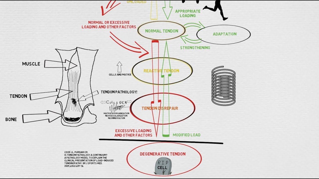 Tendinopathy Continuum and Update!