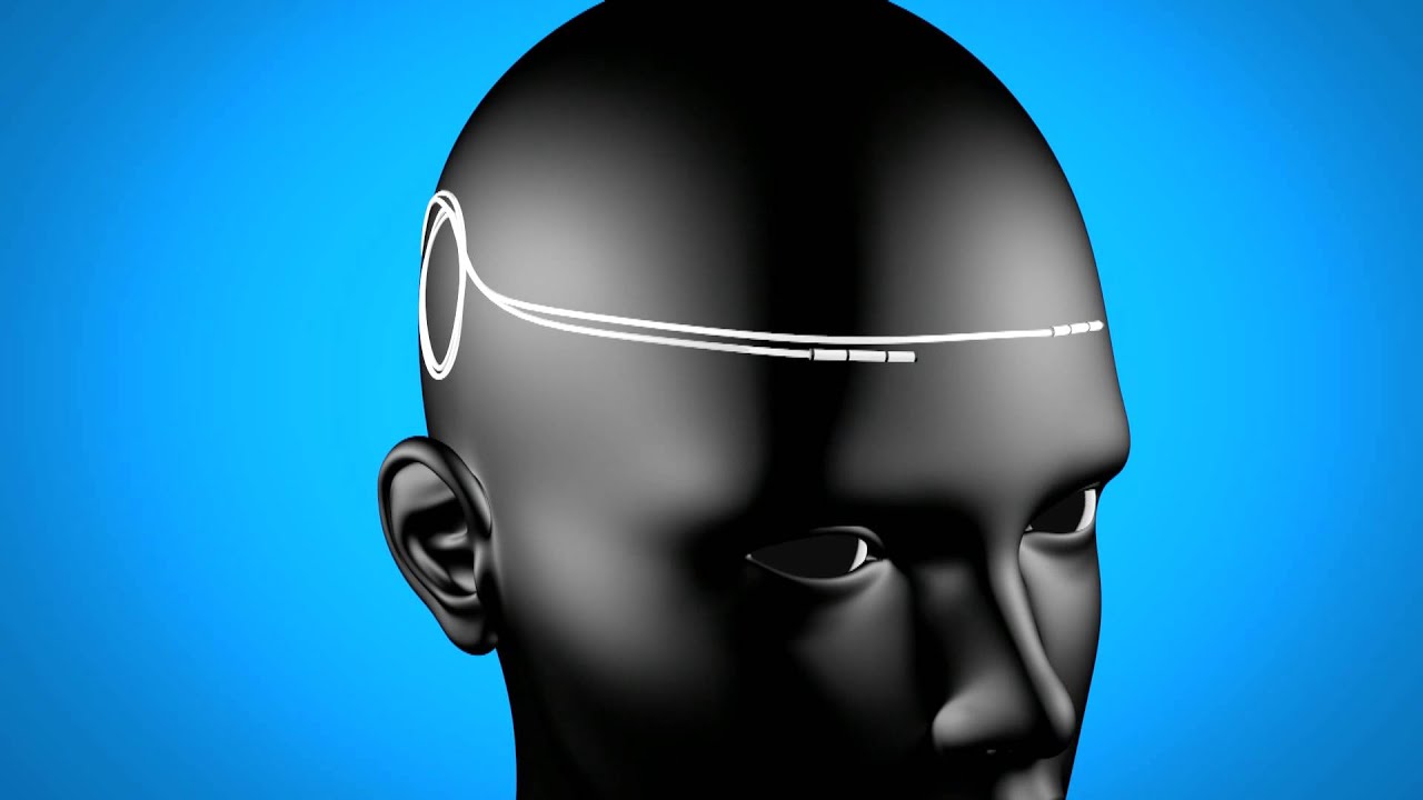 The Reed Procedure for Migraines with Dallas Pain Management Specialist Dr. Ken Reed