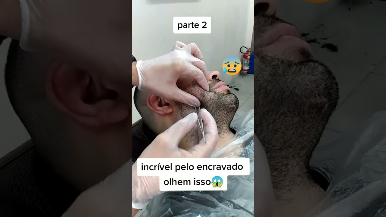 Pelo encravado 😱 Part.2 #shorts