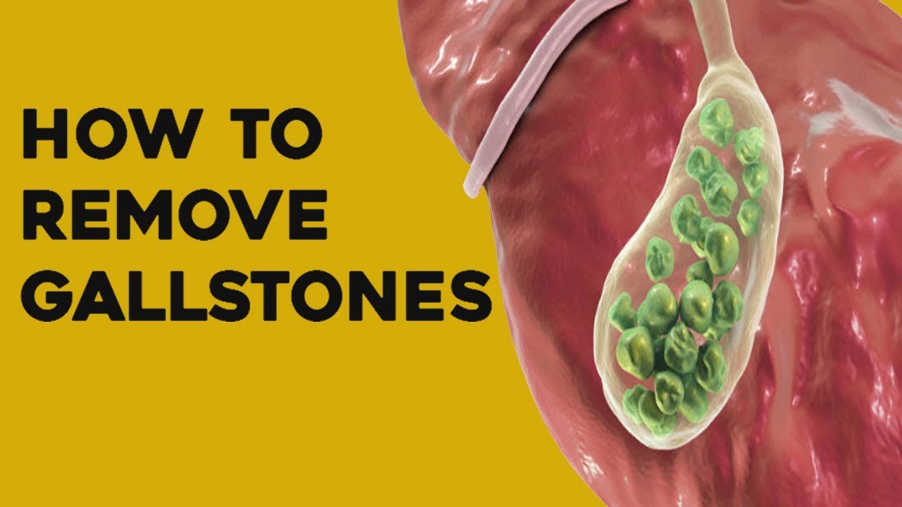 Home Remedies for Gallstones | Most Effective Natural Way To Destroy  Gallstones