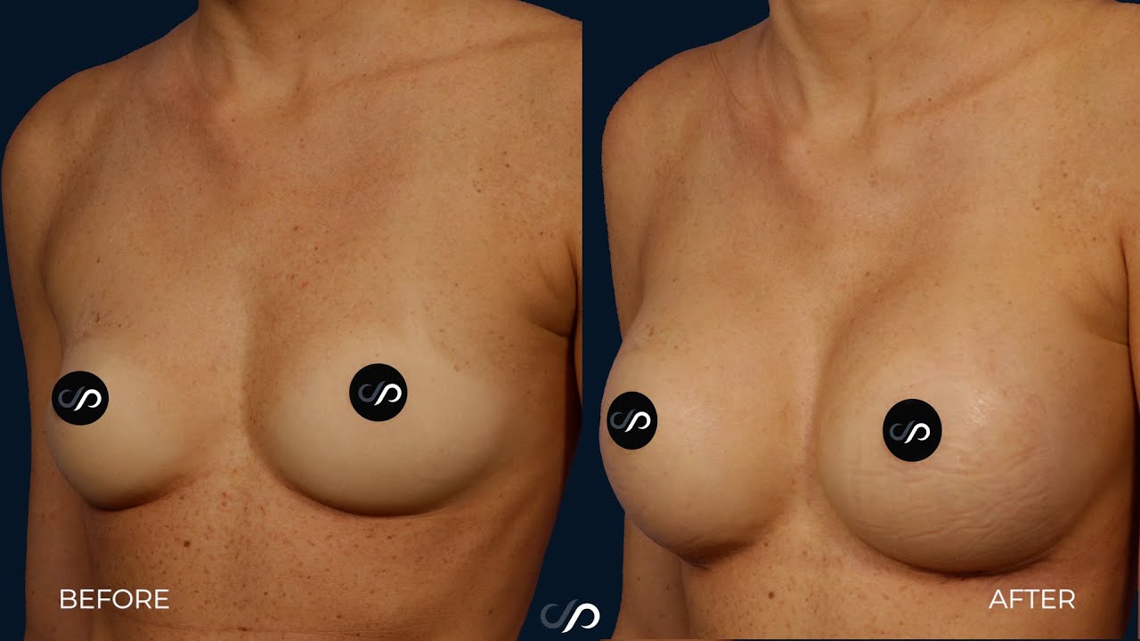 L.A. Natural Breast Augmentation | Los Angeles | Dr. David Stoker