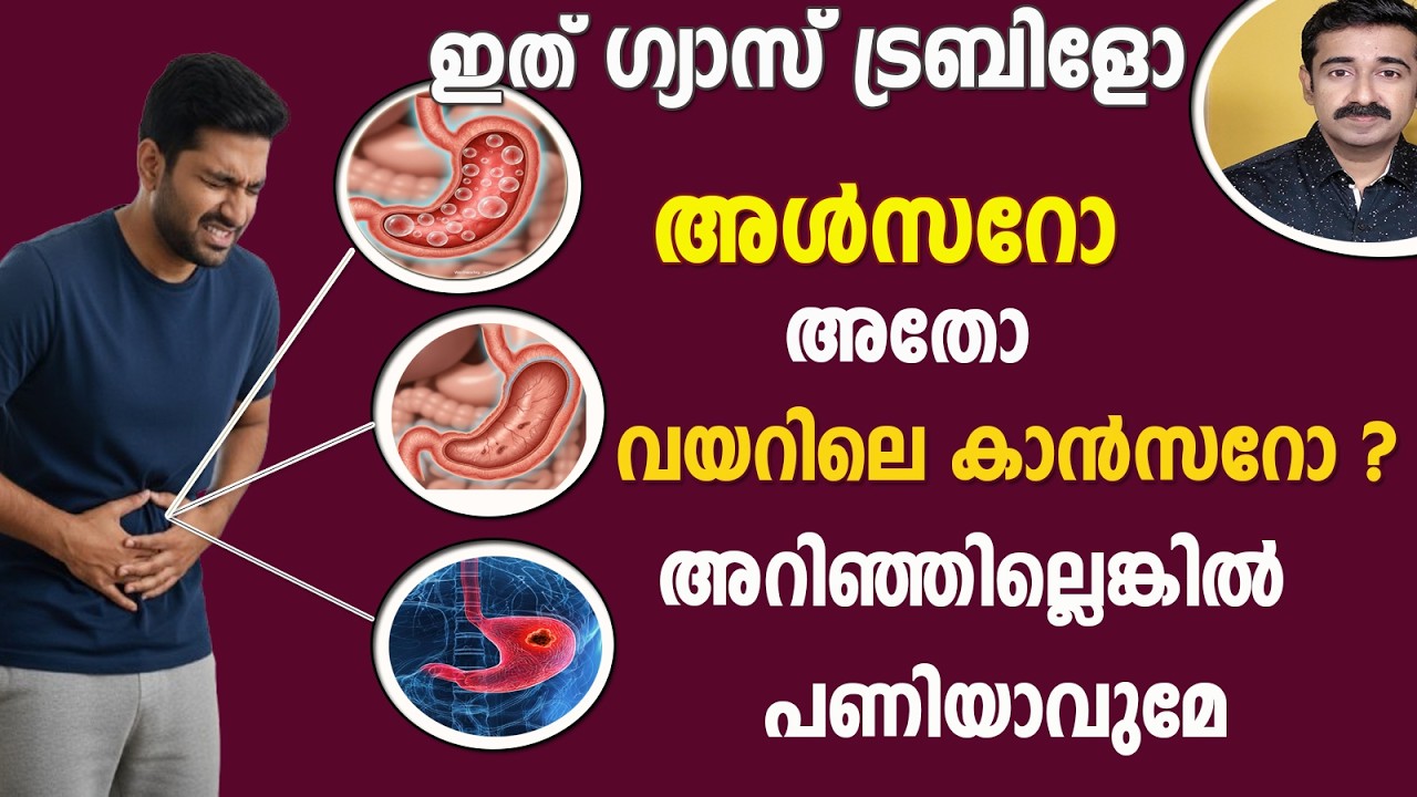 ഇത് ഗ്യാസ് ട്രബിളോ അൾസറോ അതോ വയറിലെ കാൻസറോ ? അറിഞ്ഞില്ലെങ്കിൽ  പണിയാവുമേ