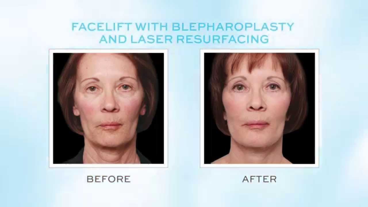 Minnesota Plastic Surgeon: Facelift Procedures