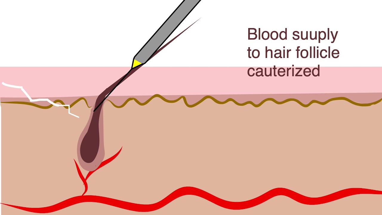 Electrolysis for hair removal