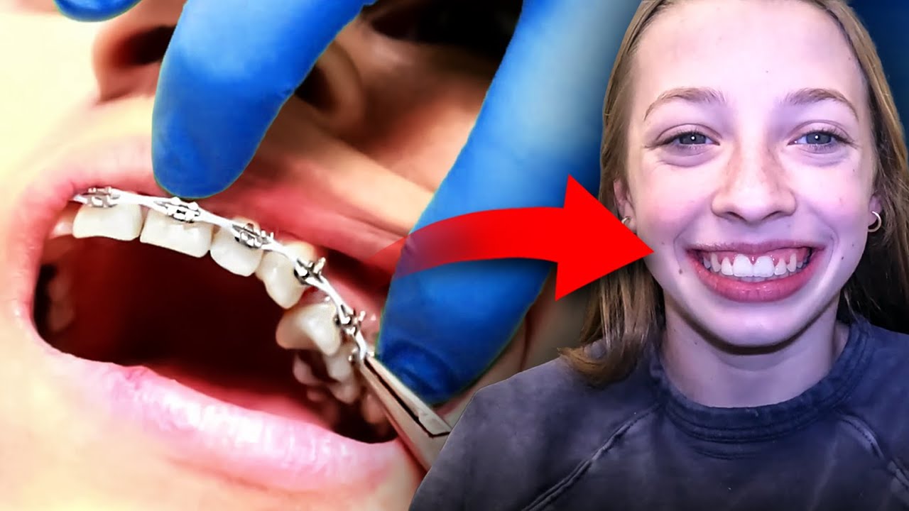 Braces off! What Happens When You Get You BRACES OFF! Texas Orthodontist