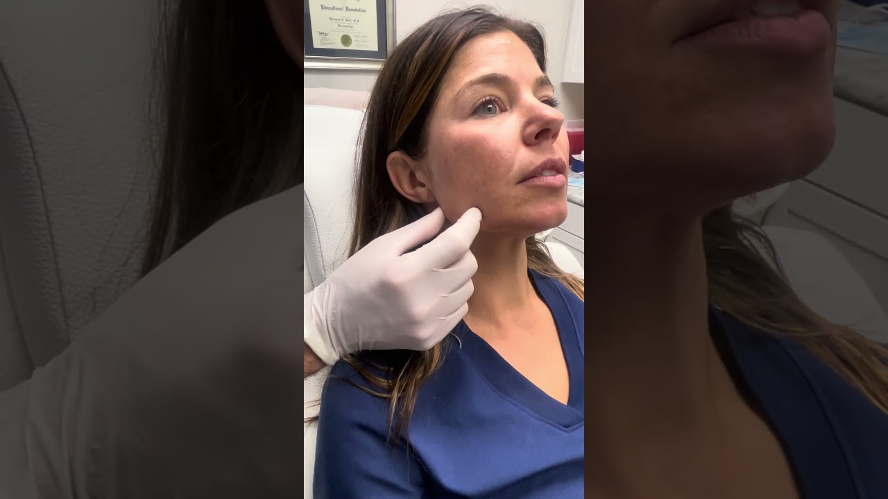 Masseter Muscle Hypertrophy / Jaw Pain Treated with Xeomin (Botox) #cosmeticdermatology