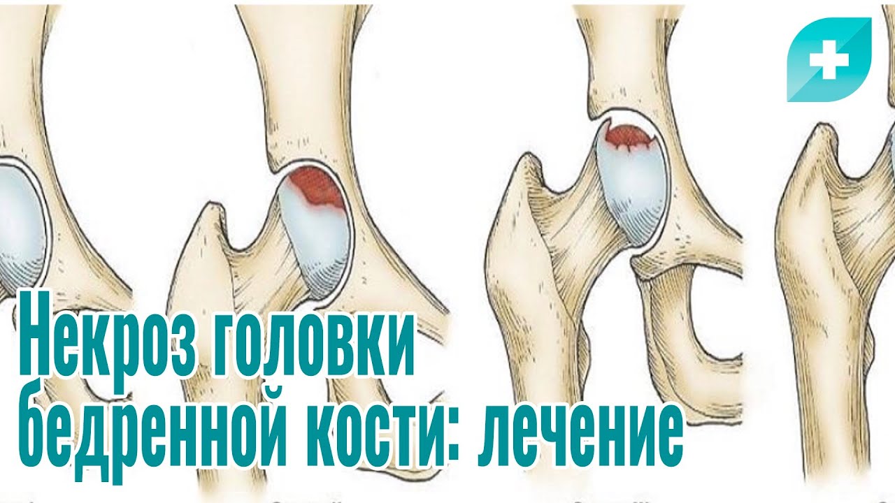 Некроз головки бедренной кости: лечение