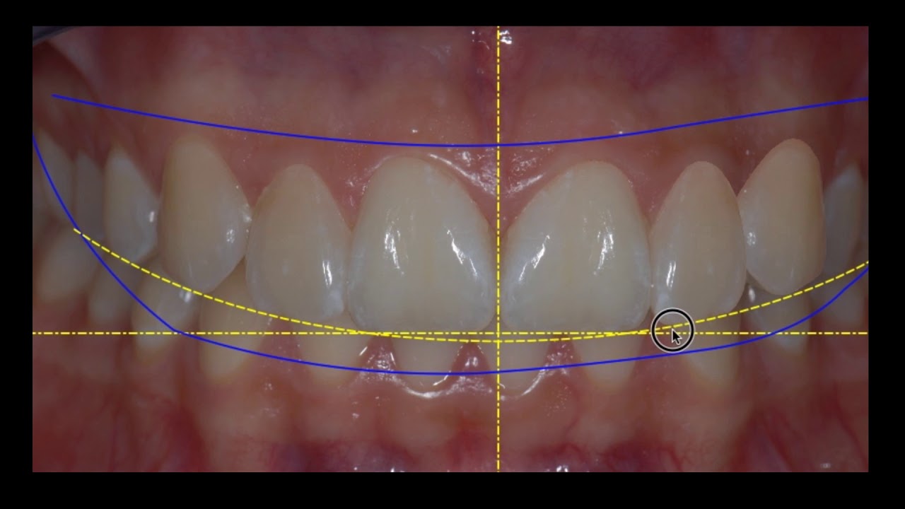 Aesthetic Digital Smile Design