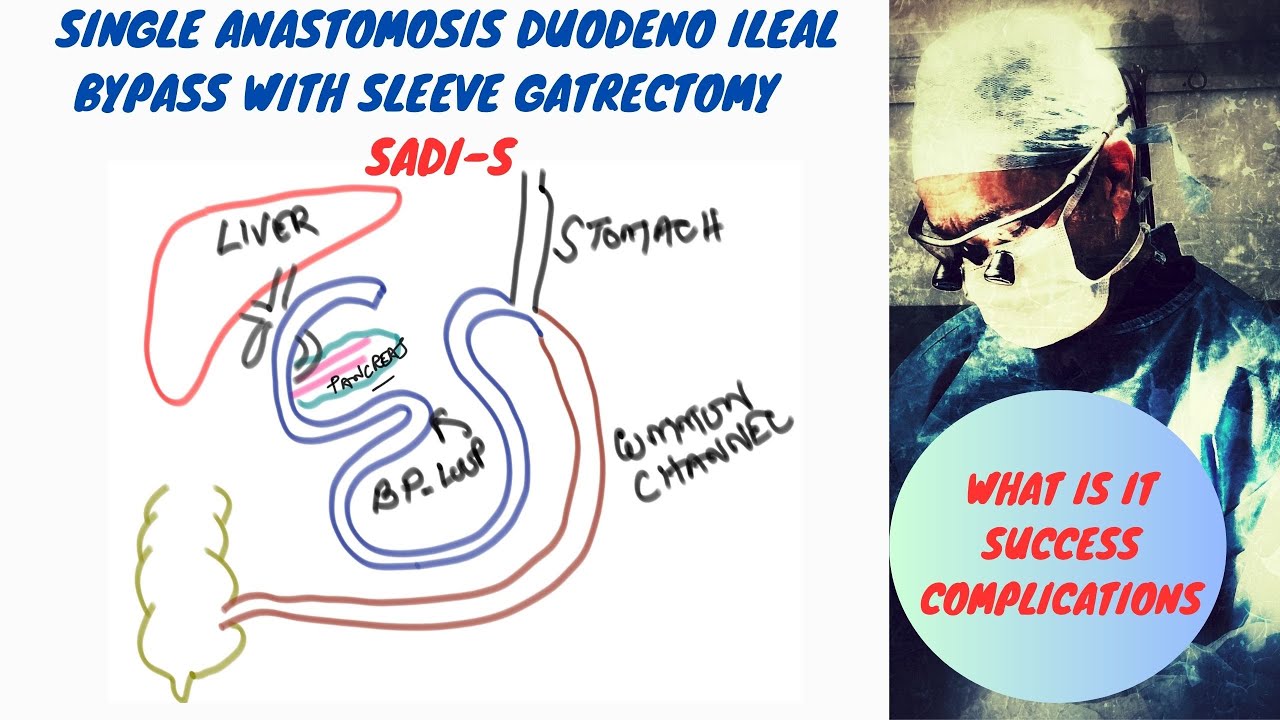 Single Anastomosis Duodeno Ileal Bypass with Sleeve Gastrectomy SADI-S