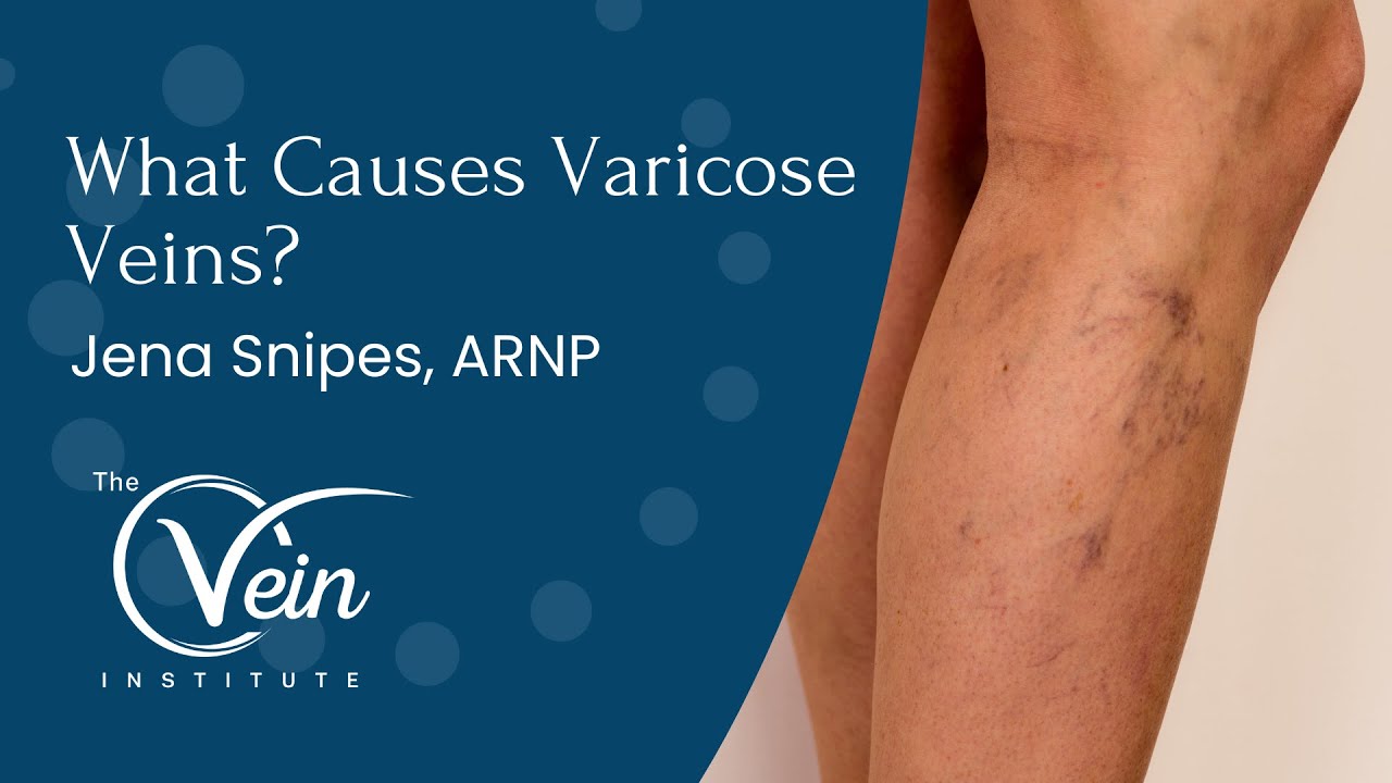 What Causes Varicose Veins? | The Vein Institute of Jacksonville