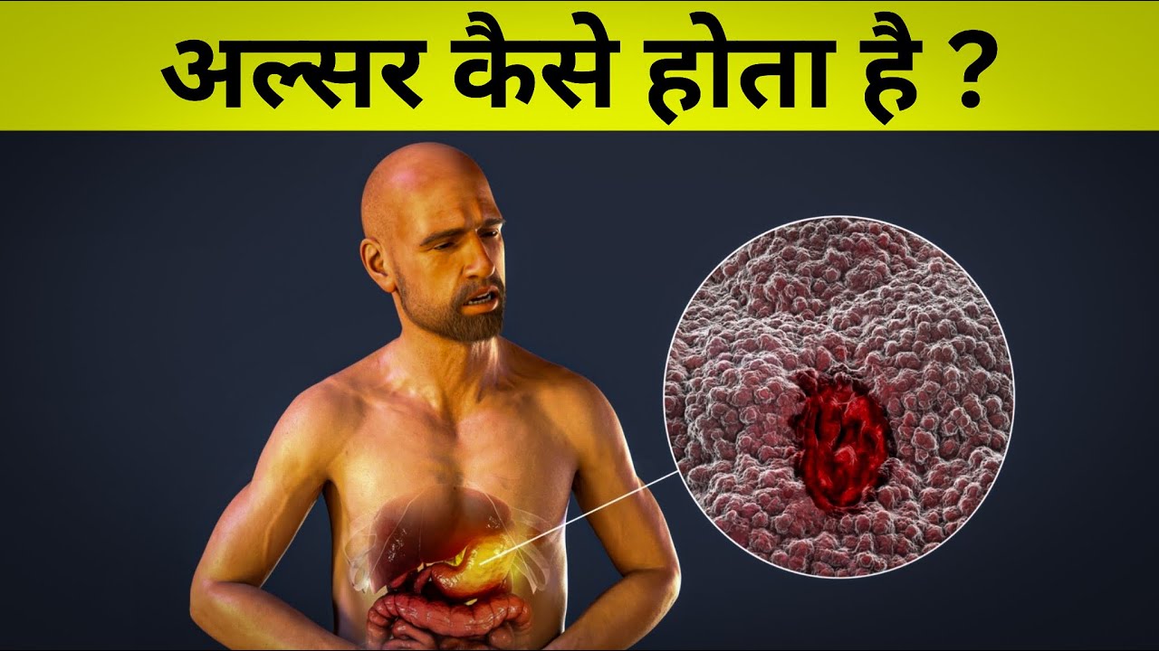 पेट में अल्सर कैसे होता हैं ? - cause of stomach ulcer