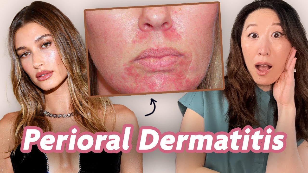 All Things Perioral Dermatitis! Reaction & Treatment Tips | Dr. Joyce Dermatologist