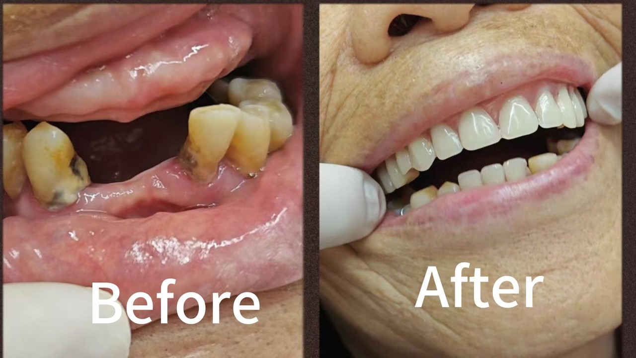 Satisfying False Teeth