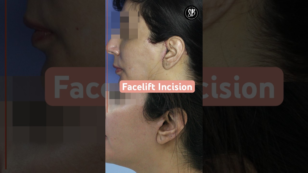 Facelift Incisions | Facelift Surgery Before After | Facelift Surgery in Hindi | SB Aesthetics