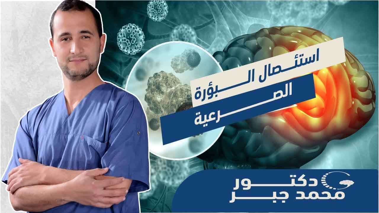 علاج الصرع عند الأطفال  تعرف  على احدث التقنيات  الجراحية |استئصال البؤرة الصرعية الدكتور محمد جبر