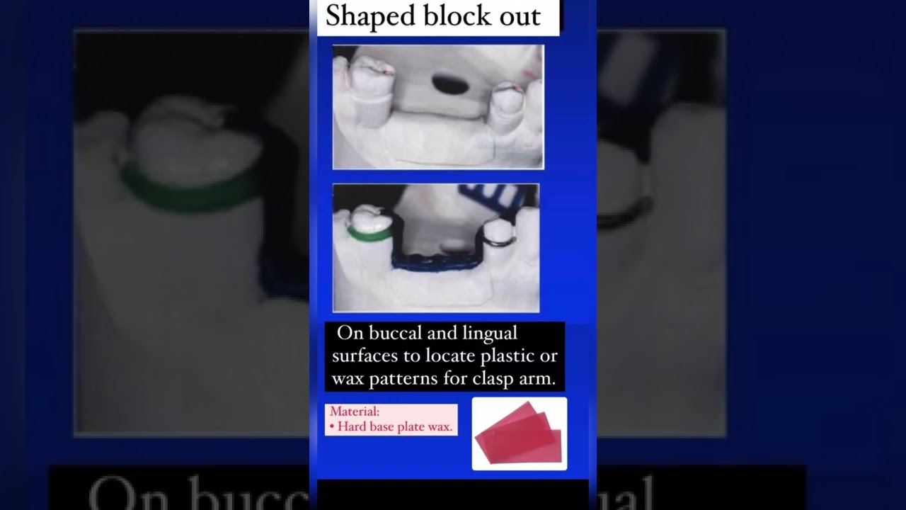 Block out and relief by Dr.Aya Ibrahim