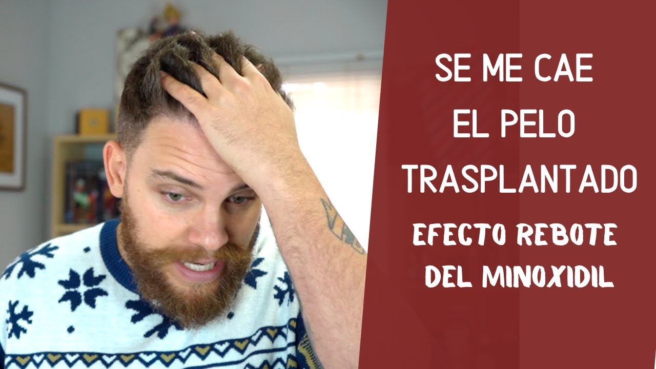 SE ME HA CAÍDO EL PELO TRASPLANTADO: SUFRO EL EFECTO REBOTE DEL MINOXIDIL
