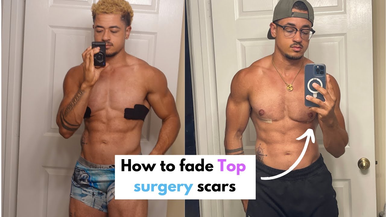 How to fade top surgery scars FTM