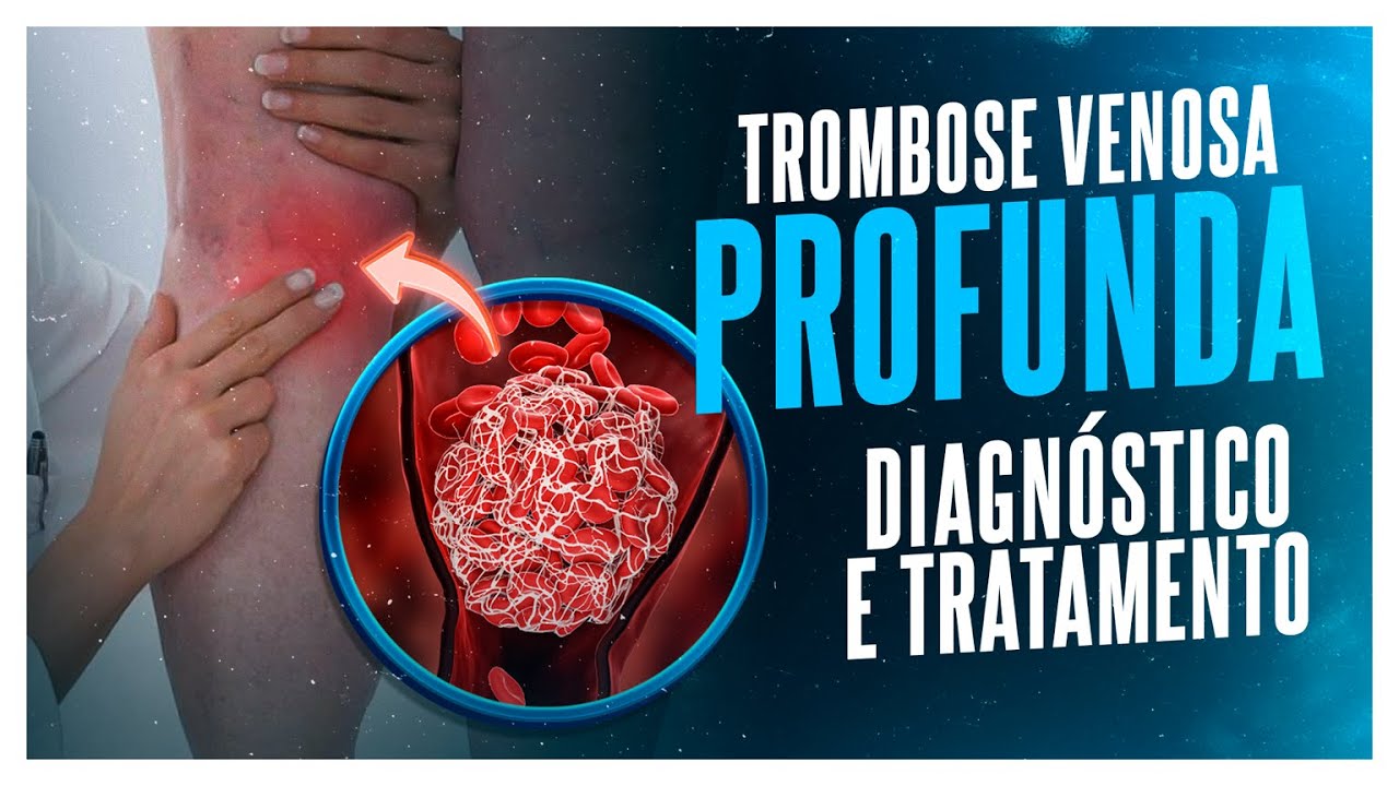 TROMBOSE VENOSA PROFUNDA - DIAGNÓSTICO  E TRATAMENTO