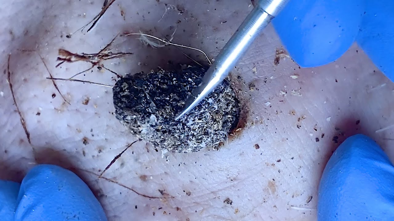[ASMR] TLC DR LEE&rsquo;S ULTIMATE ZITPOPPER with Tweezer 🌝 とんでも454554