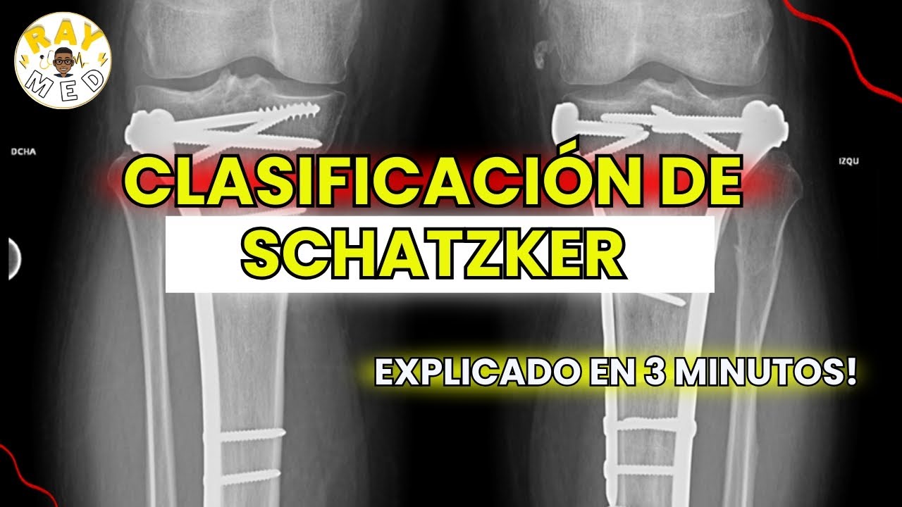 🦴 Fractura de Meseta Tibial: Clasificación de Schatzker