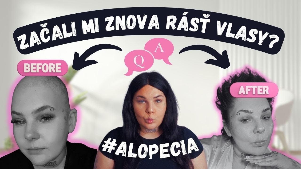 Začali mi znova rásť vlasy? 🤯 Jediný produkt, ktorý mi pomohol!!!! #alopecia
