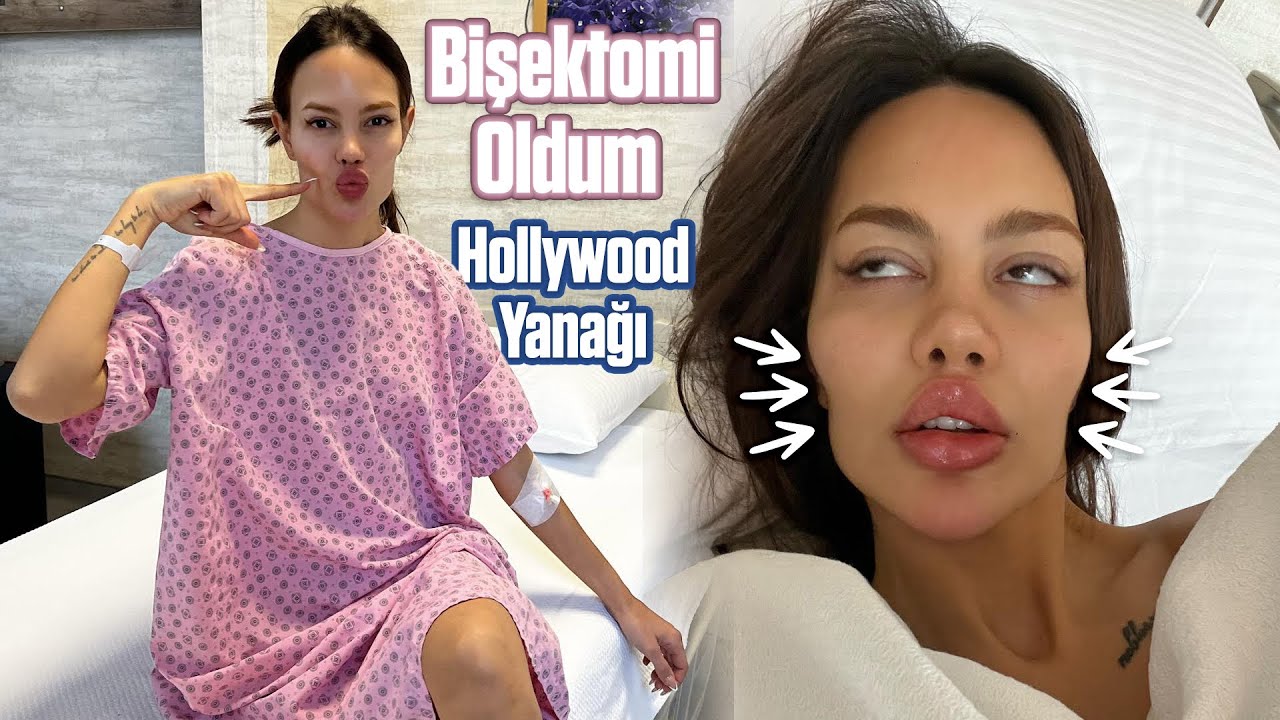 BİŞEKTOMİ SÜRECİM - Yanak Yağlarımı Aldırdım