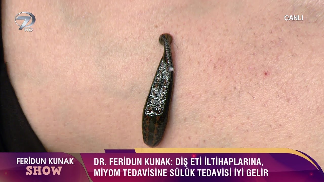 Tedavide Çığır Açan Mucizevi Etki: Sülük!