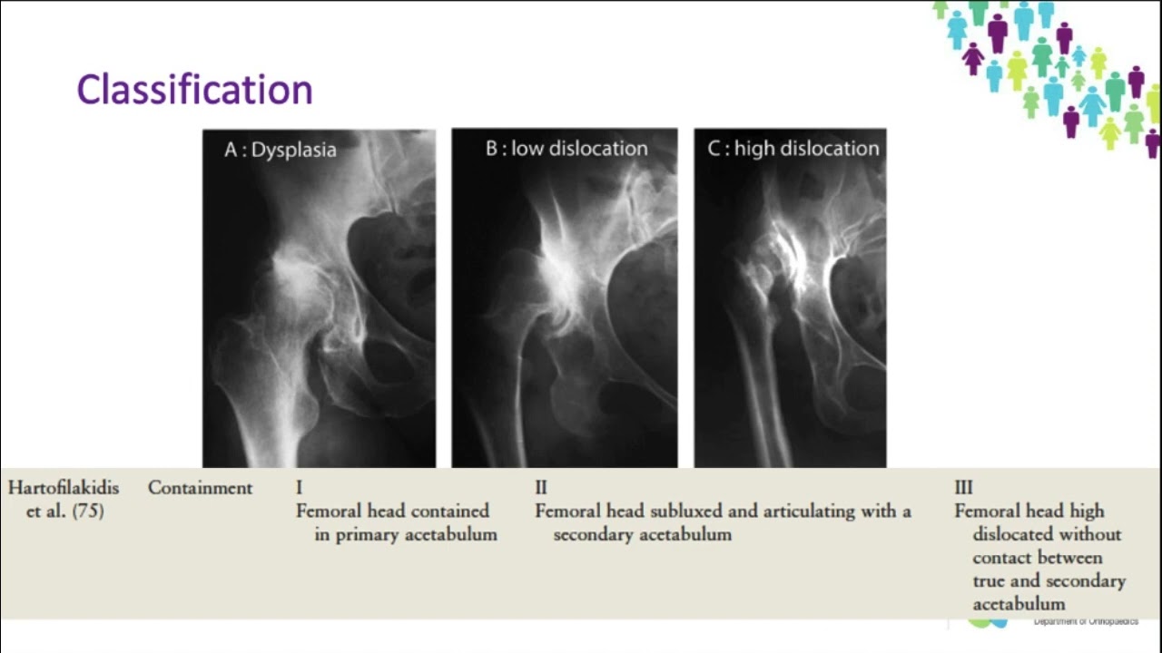OrthoFracs - Adult Hip Dysplasia by Dr Karen Bourns