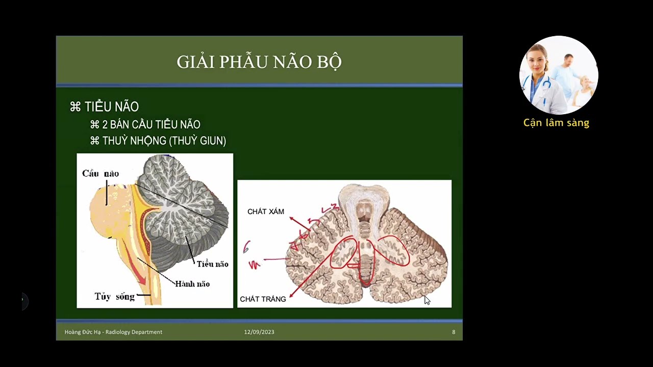 CHẨN ĐOÁN HÌNH ẢNH MỘT SỐ DỊ DẠNG HỆ THẦN KINH | TS. BS. Hoàng Đức Hạ