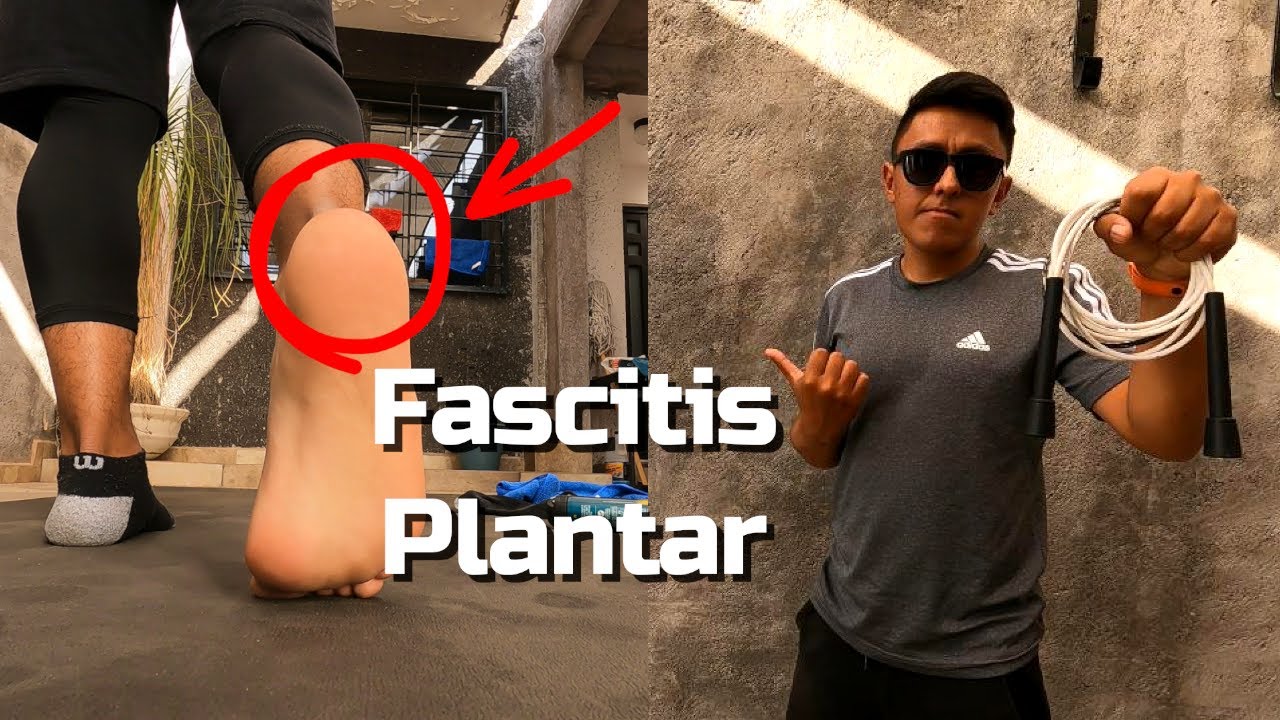 FASCITIS PLANTAR | DOLOR EN LA PLANTA DEL PIE