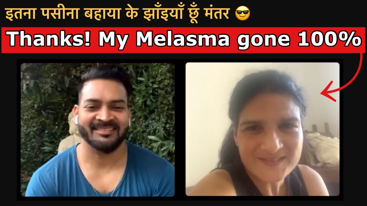 Thanks! My Melasma gone 100%. इतना पसीना बहाया के झाँइयाँ छूँ मंतर 😎