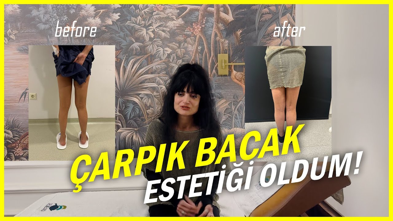 Çarpık Bacak Ameliyatı Olan Hastamızın Yorumları