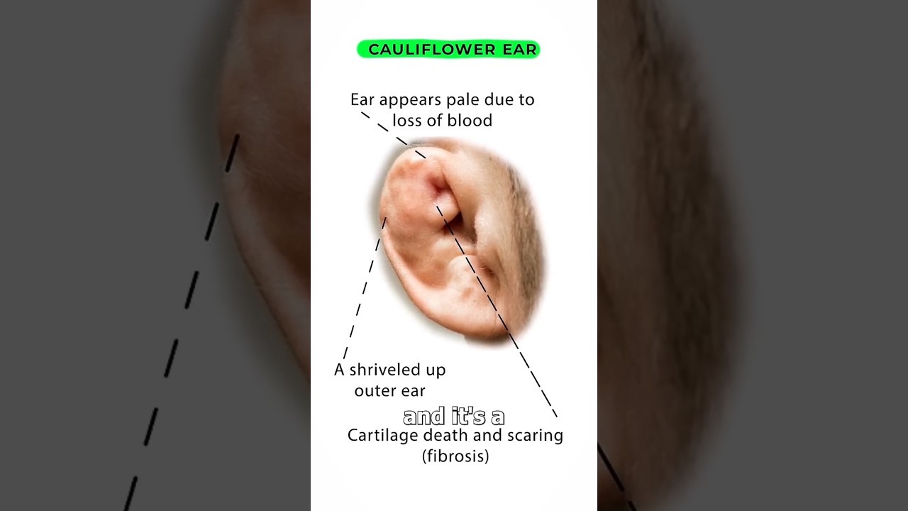 Shocking Truth: Athletes' Cauliflower Ear Mystery 