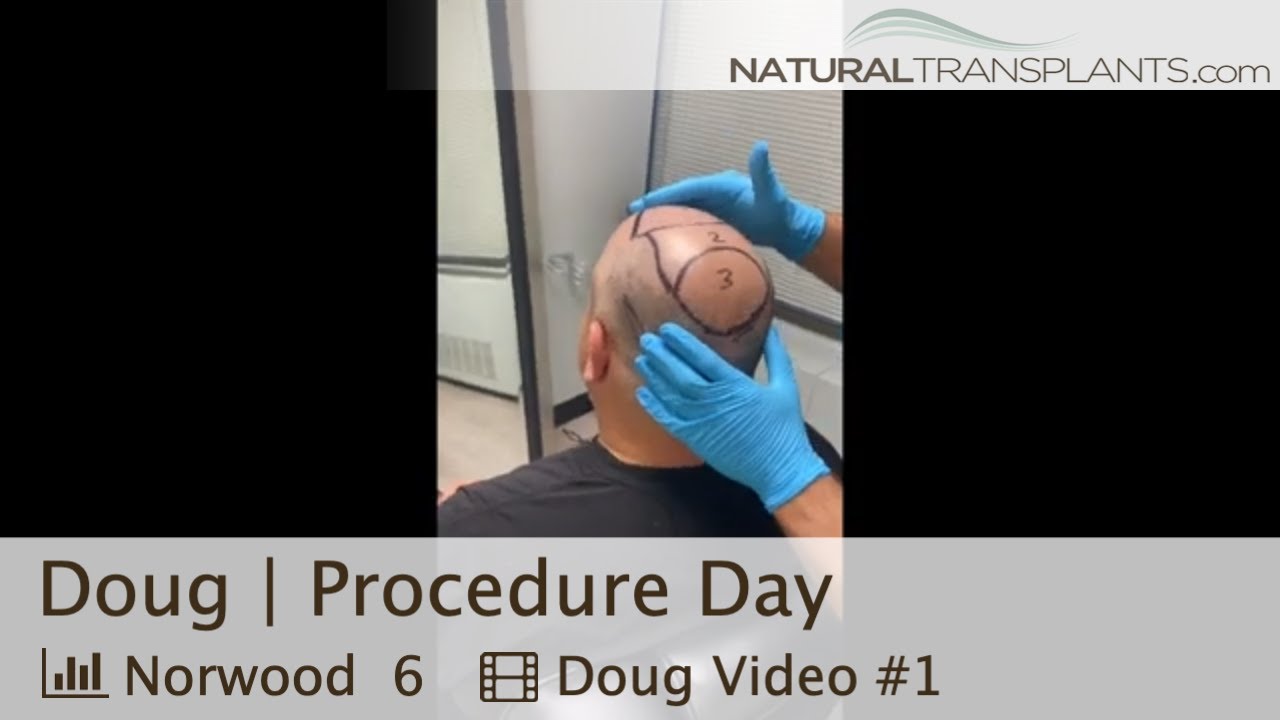 Norwood 6 Hair Transplant Procedure Day With Tons of Density! | Dr. Blumenthal (Doug)