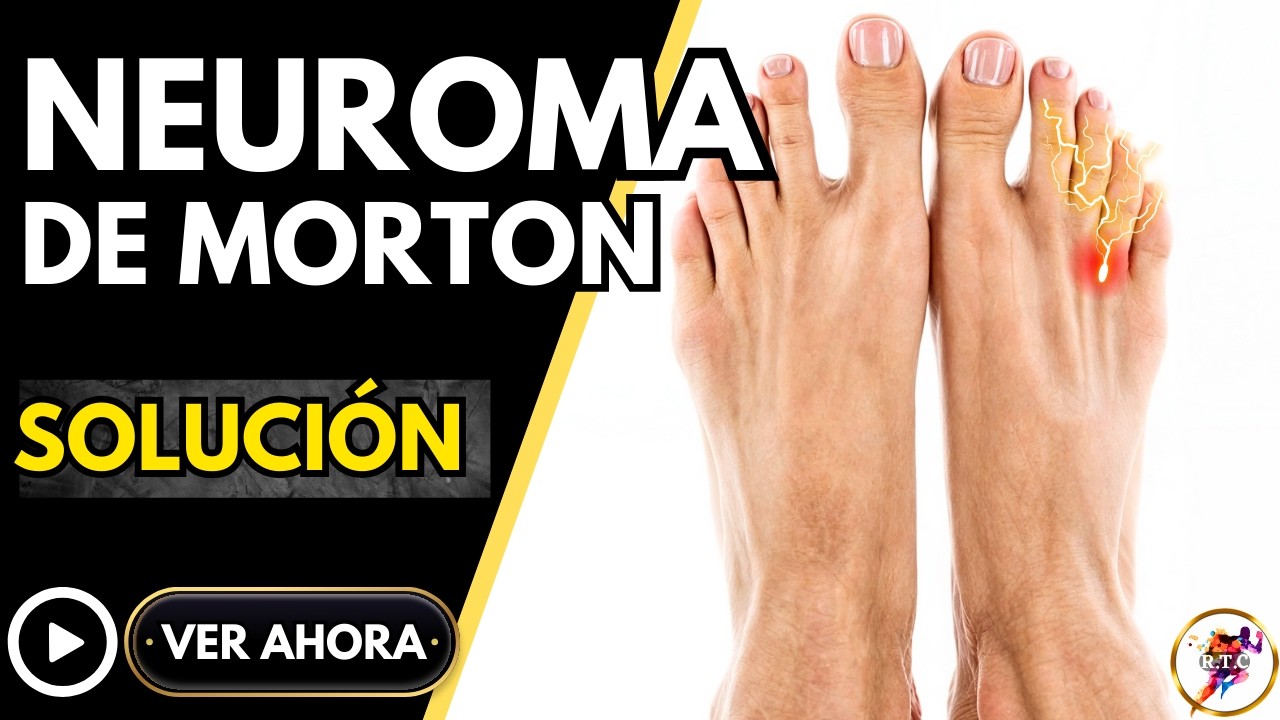 Cómo SOLUCIONAR el NEUROMA de Morton. EJERCICIOS