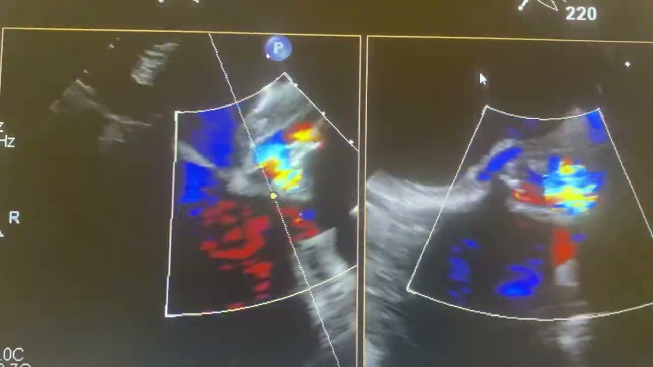 Paraaortic Abcess by H/o of Mechanical valve replacement