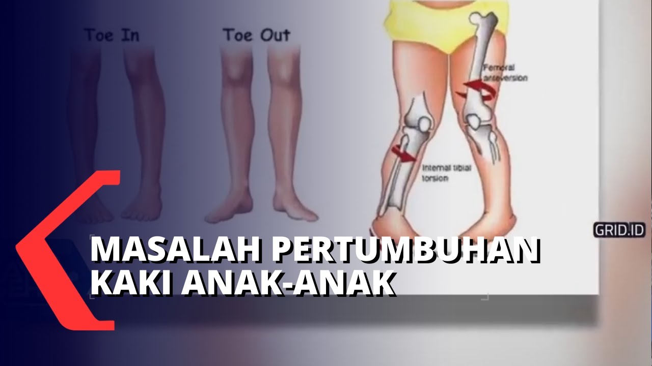 Cara Mencegah Kelainan Bentuk Kaki Bayi dan Anak-anak