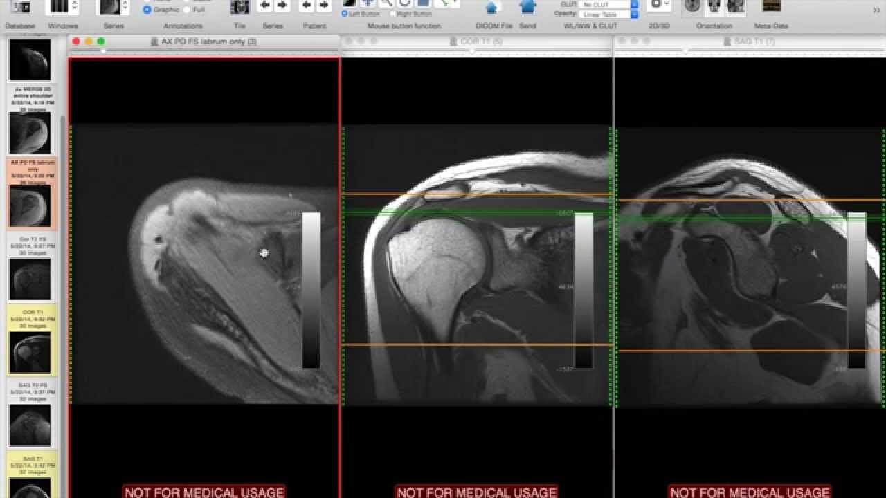 Systematic Interpretation of Shoulder MRI: How I do it