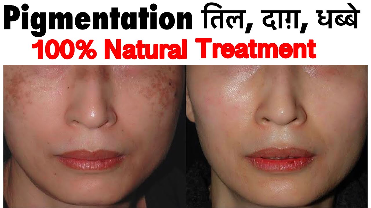 How to Remove Dark Spots, Pigmentation, Brown Spots Permanently | JSuper kaur
